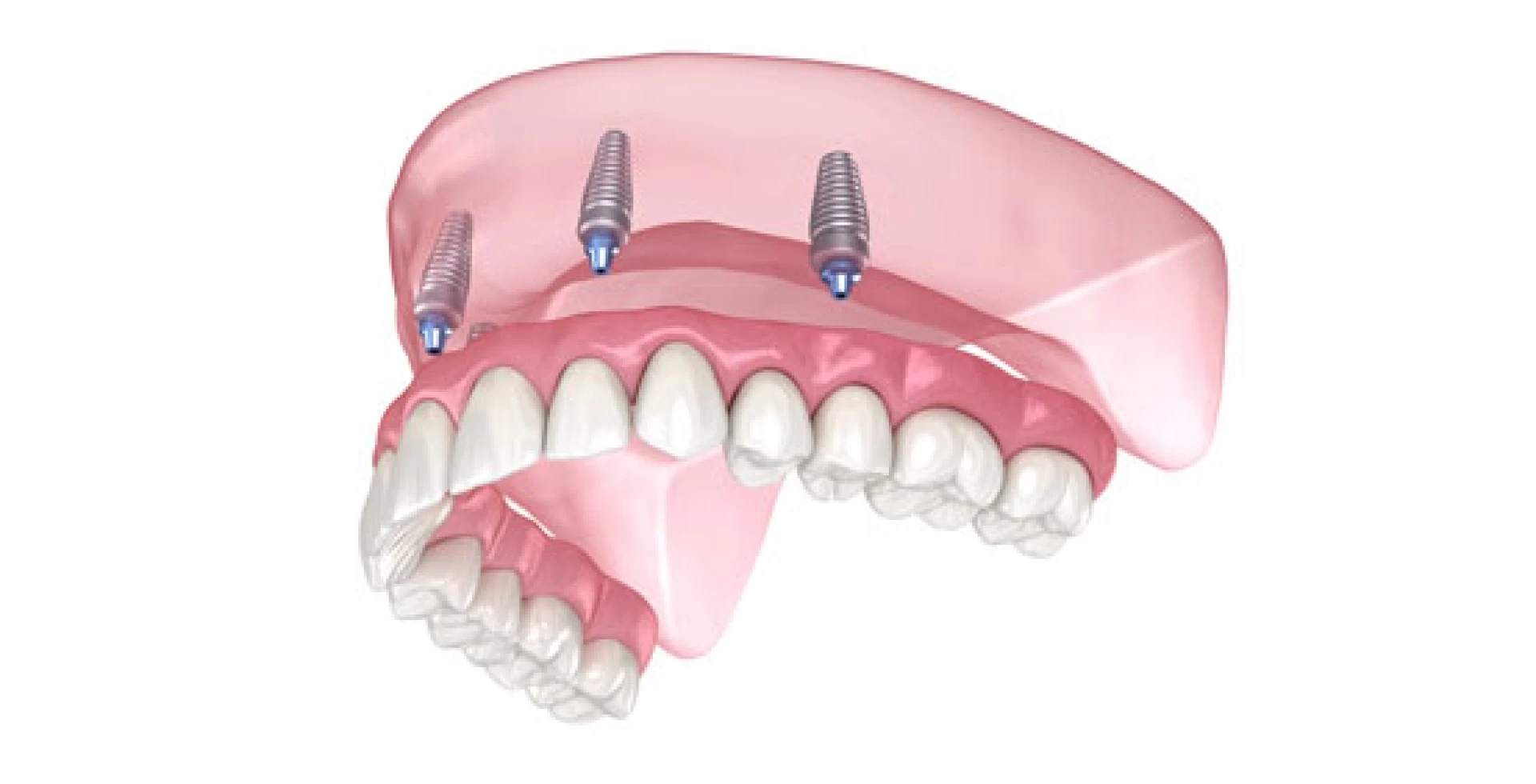 Implante Dentário