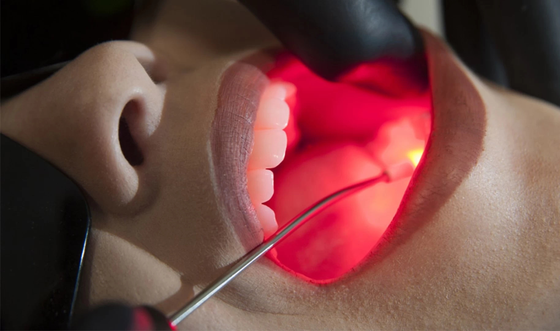 Laser Terapia Dental