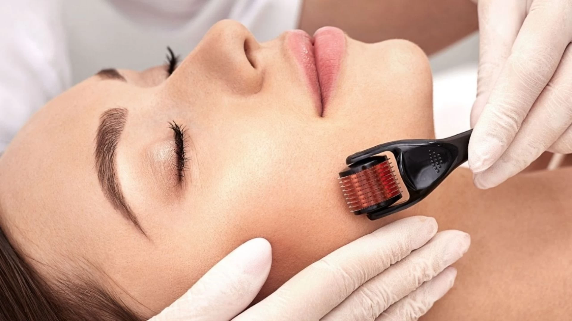 Microagulhamento facial